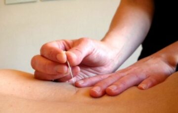 Medical Acupuncture